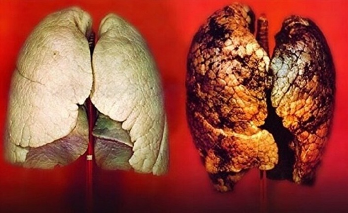 Akciğer kanserinde erken tanı tedavide başarı oranını arttırıyor